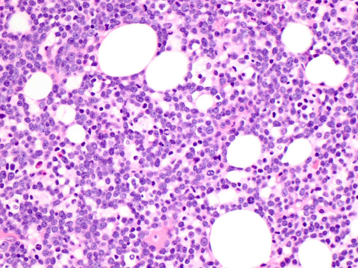 Bone marrow biopsy 100x